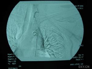 顱內肉芽腫性動脈炎
