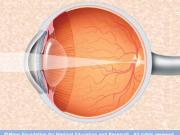 眼科手術保險