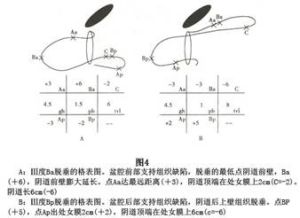 絕經期盆腔臟器脫垂