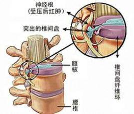 急性腰椎間盤突出 急性腰椎間盤突出