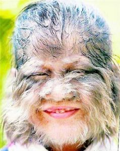 狼人綜合徵 狼人綜合徵