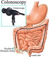 腸鏡檢查 腸鏡檢查