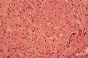 多發性骨髓瘤病腎病 多發性骨髓瘤病腎病