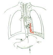 縱隔氣腫 縱隔氣腫