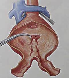 （圖）發病機制