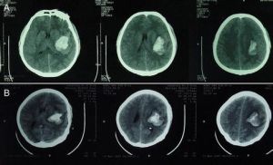 腦內血腫 腦內血腫