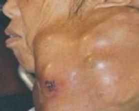 腮腺混合瘤 腮腺混合瘤