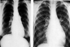 急性肺源性心臟病