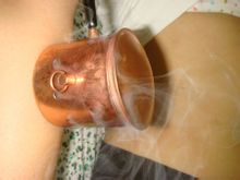 溫灸器灸演示圖