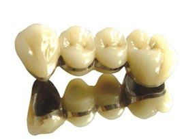 鈦合金烤瓷牙 鈦合金烤瓷牙