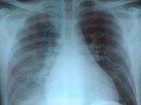 肺門舞蹈症 肺門舞蹈症