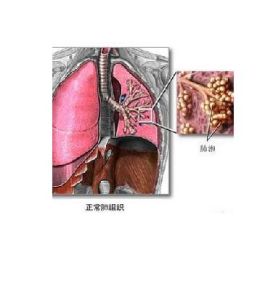 休克性肺炎 休克性肺炎