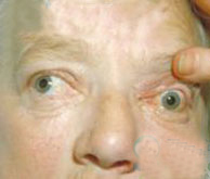 內分泌性眼球突出 內分泌性眼球突出