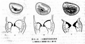 二尖瓣瓣膜替換術