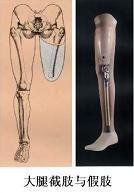 大腿假肢 大腿假肢