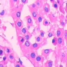 腎嗜酸細胞瘤 腎嗜酸細胞瘤