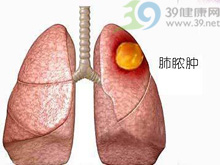 急性肺膿腫