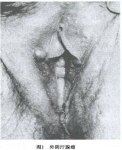 外陰大汗腺瘤