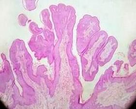 乳頭狀瘤 乳頭狀瘤