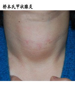 橋本氏甲狀腺炎