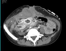 腹壁硬纖維瘤 腹壁硬纖維瘤