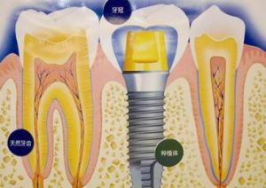 I-LIVE種植牙 I-LIVE種植牙