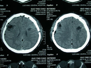 海綿狀腦血管瘤