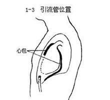 心包切開引流術