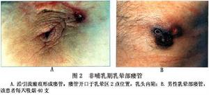 非哺乳期乳暈部瘺管