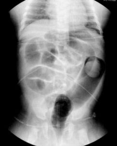 小兒腸套疊 小兒腸套疊