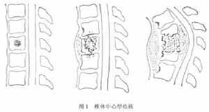 單純性脊柱結核