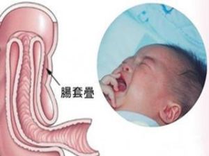 急性腸套疊 急性腸套疊