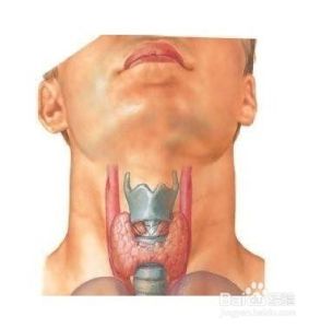 大脖子病 大脖子病