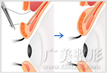 重瞼手術 重瞼手術