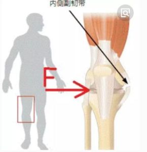 膝關節內側副韌帶損傷 膝關節內側副韌帶損傷