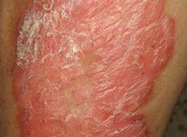 鱗屑樣痂皮 鱗屑樣痂皮