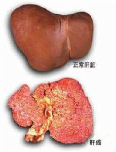 肝癌症狀之發熱 肝癌症狀之發熱