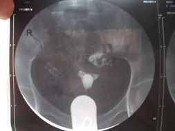 右側輸卵管傘端積水 右側輸卵管傘端積水