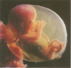 羊膜腔感染綜合徵