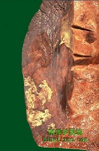 肺炎克雷白桿菌肺炎