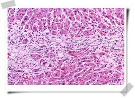 活動性肝炎 活動性肝炎