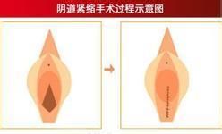 韓式納米微創無痕陰道緊縮術 韓式納米微創無痕陰道緊縮術