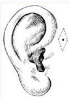 單純性中耳炎 單純性中耳炎