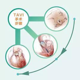 瓣膜置換 瓣膜置換