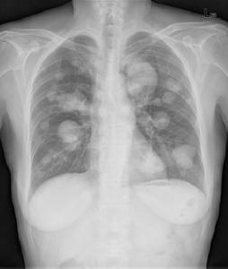 肺轉移瘤 肺轉移瘤