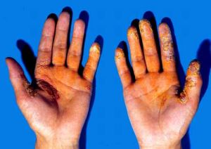 連續性肢端皮炎 連續性肢端皮炎