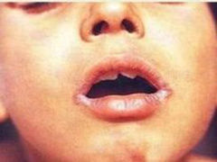 核黃素缺乏 核黃素缺乏