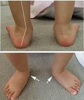 足外翻 足外翻