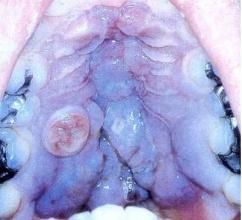 卡波西肉瘤 卡波西肉瘤