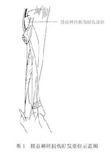 腓總神經卡壓症